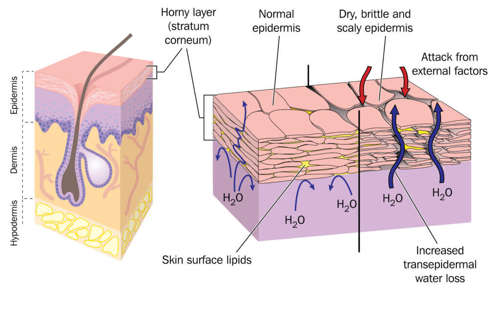 Figure 1. Cross section of skin showing normal epidermis. Figure 2. Structure of the surface of skin with water loss - dry, brittle and flaky skin.