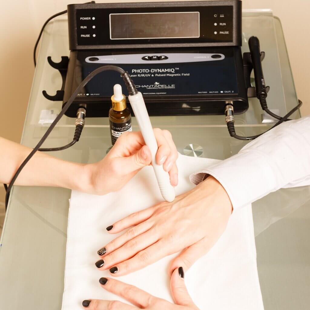 laseroterapia photodynamiq Chantarelle