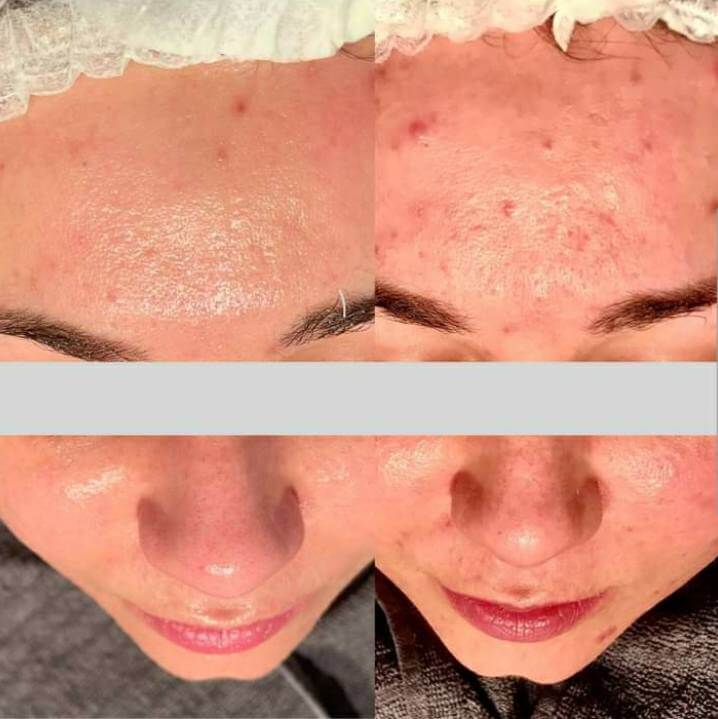 Efekty zabiegow przed i po Tradzik pospolity na czole Chantarelle laseroterapia