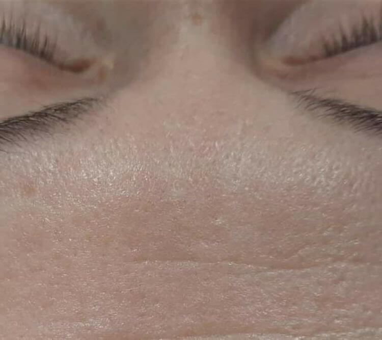 Lwia zmarszczka laseroterapia Chantarelle PO