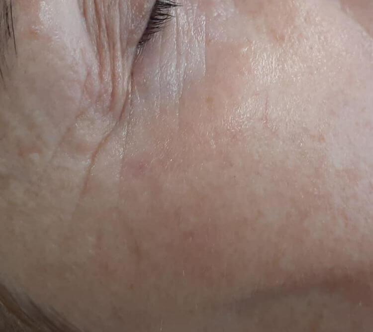 Odmlodzenie przeciwzmarszkowy zabieg laser plant plasma Chantarelle PO fot Katarzyna Buczek