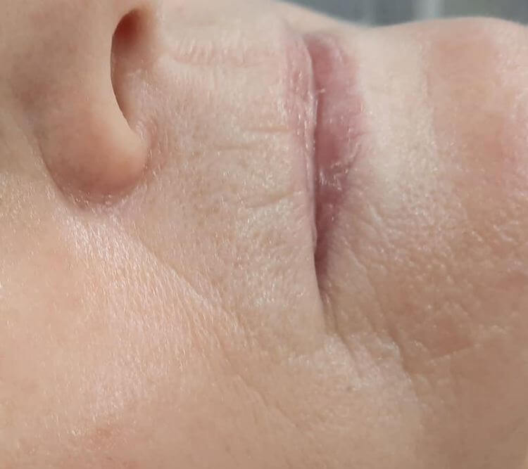 Odmlodzenie skory wokol ust PO Chantarelle Royal STUDIO