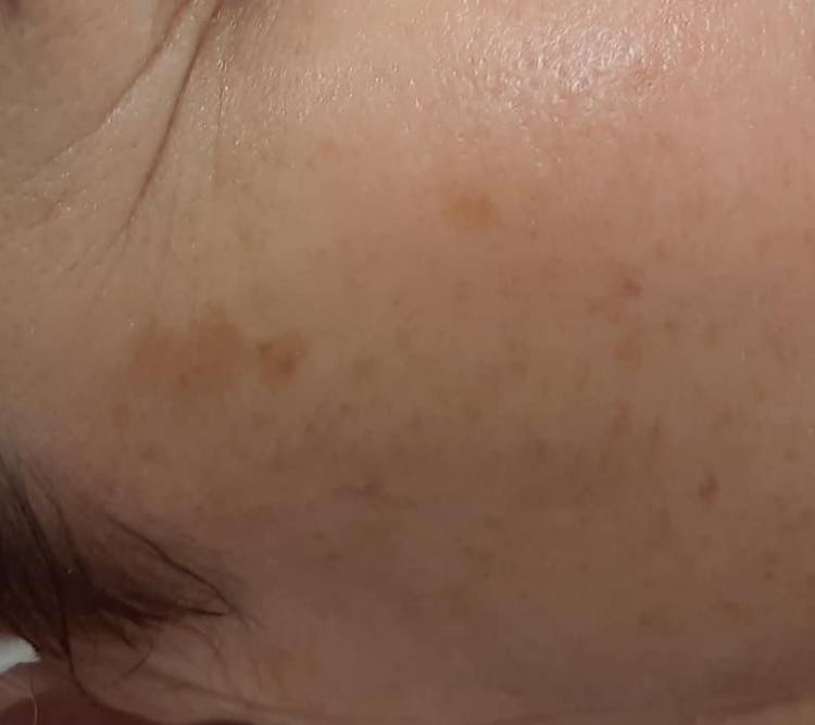 Plamy posloneczne niedoskonalosci PRZED Chantarelle