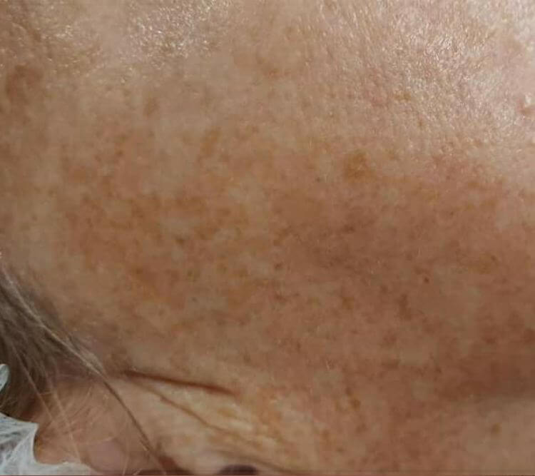 Plamy przebarwienia PRZED Chantarelle