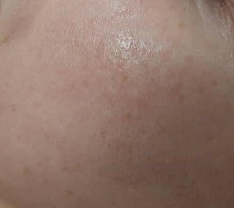 Przebarwienia nierownosci niedoskonalosci Chantarelle PRZED