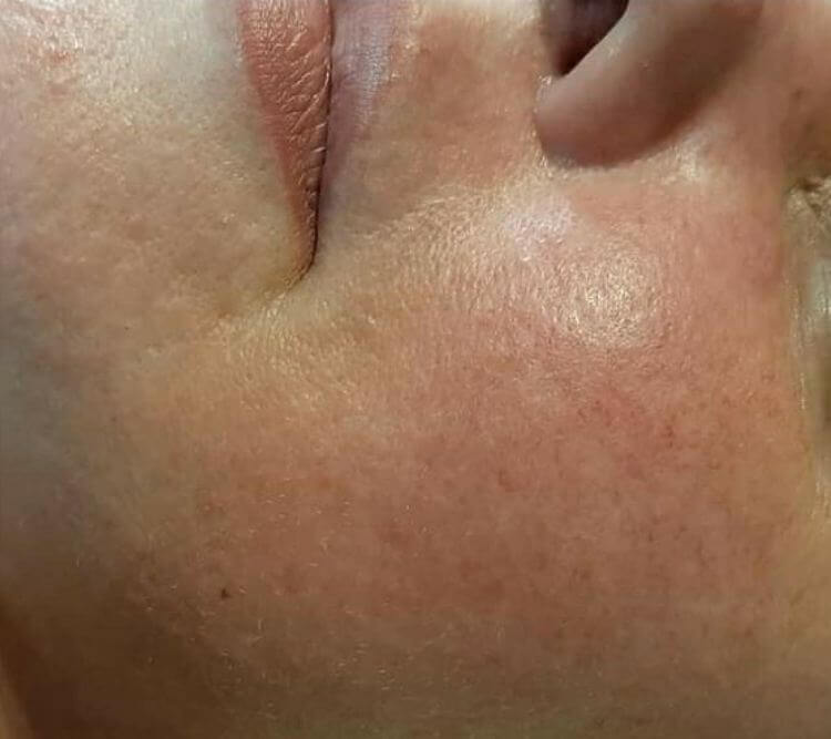 Przebarwienia plamy niedoskonalosci PRZED Chantarelle