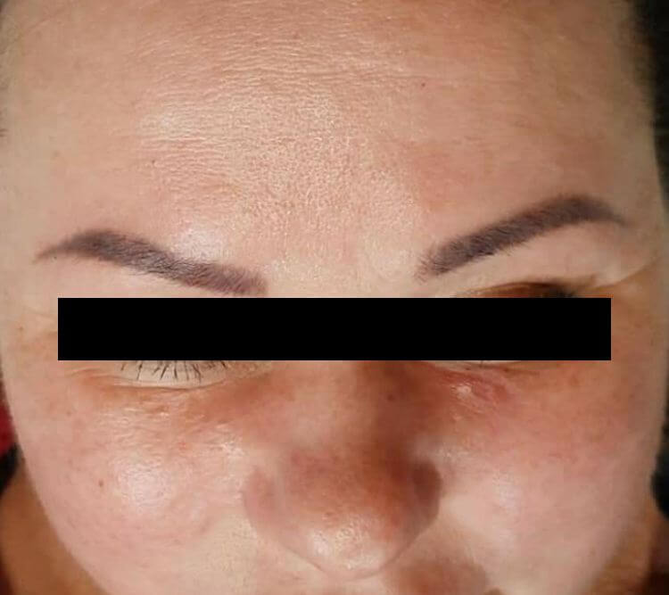 Redukcja rumienia zaczerwienien rosacea PO Chantarelle