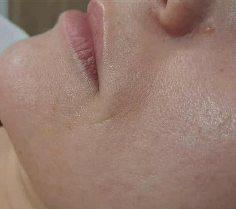 Redukcja zmarszczek wokol ust laseroterapia Plant Plasma Chantarelle PO