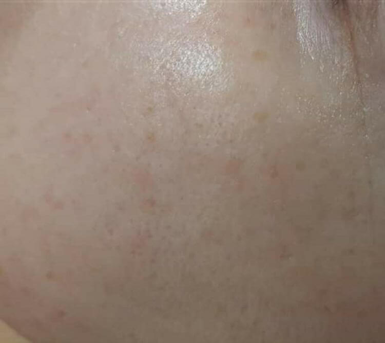 Rozjasnianie depigmentacja odmlodzenie Chantarelle Plant Plasma PRZED