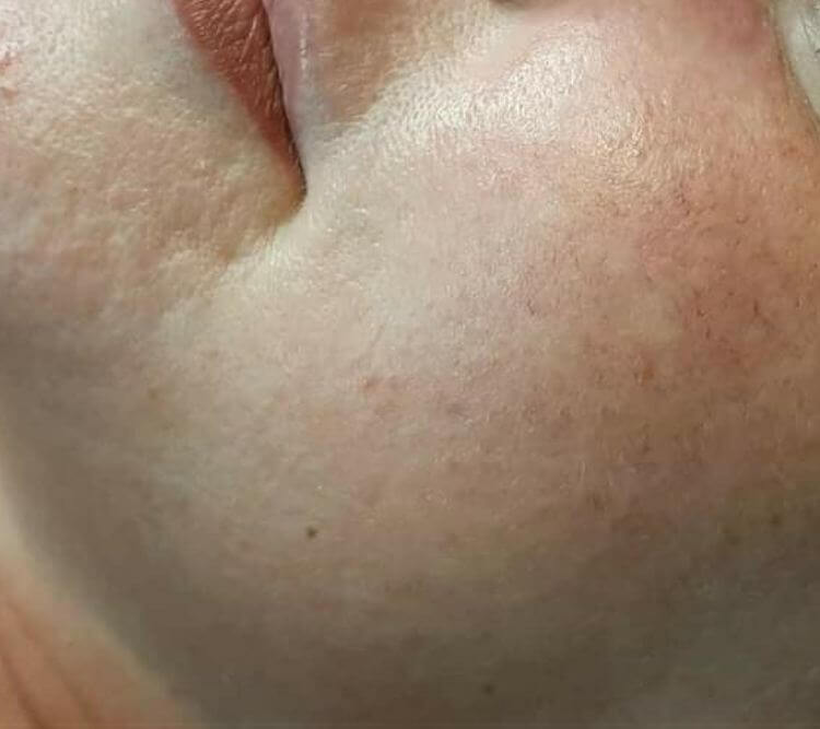 Rozjasnienie odmlodzenie wyrownanie kolorytu laseroterapia PO Chantarelle