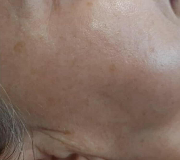 Zabieg na plamy przebarwienia nierownosci PO Chantarelle Laseroterapia