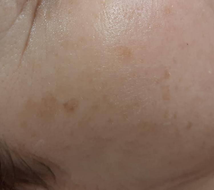 Zabiegi depigmentujace PO Chantarelle