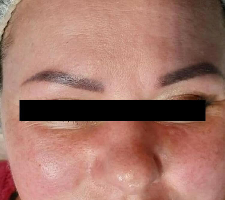 Zaczerwienienia tradzik rozowaty skora nadwrazliwa PRZED Chantarelle