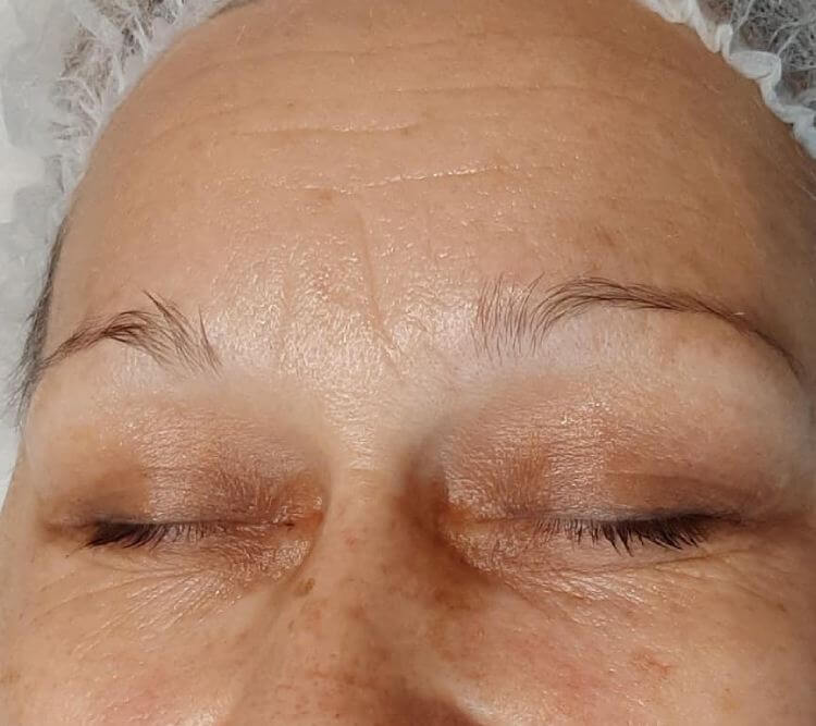 Zmarszczki mimiczne laser PO Chantarelle fot Katarzyna Buczek