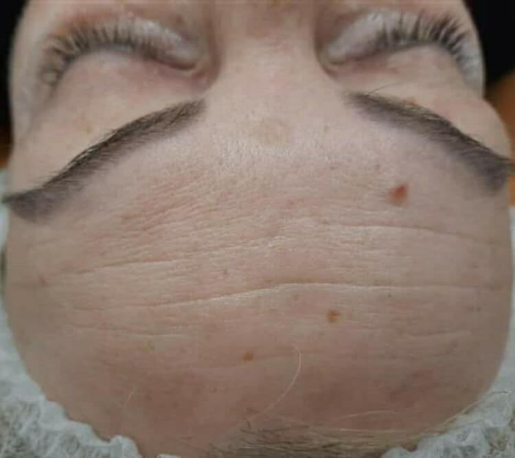 Zmarszczki na czole PRZED laseroterapia Chantarelle