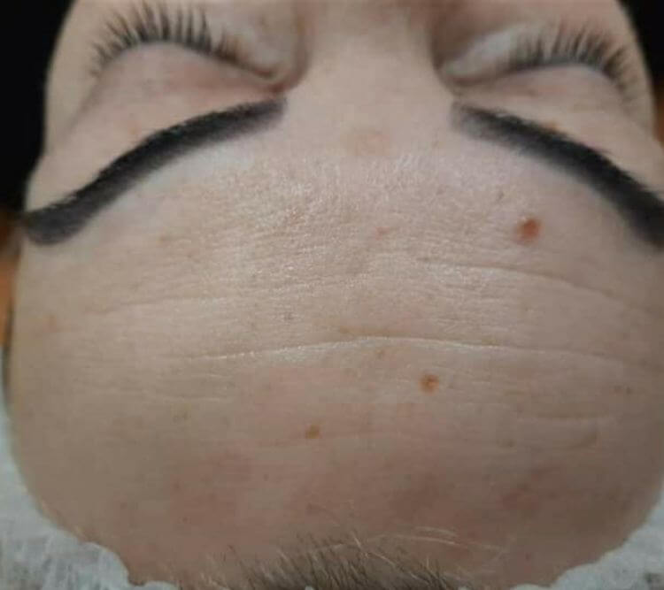 Zmarszczki na czole laseroterapia 1 zabieg Chantarelle PDT Master Black Essential