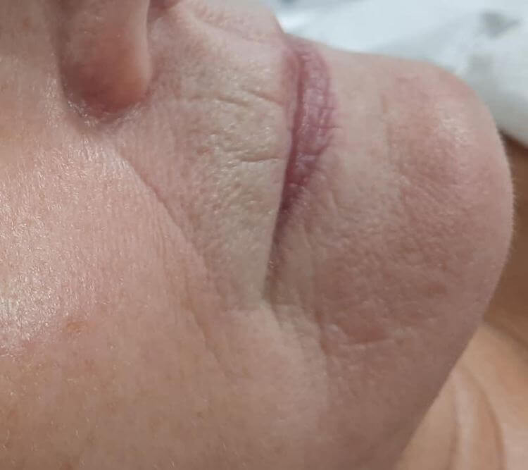 Zmarszczki wokol ust PRZED Chantarelle ROYAL STUDIO