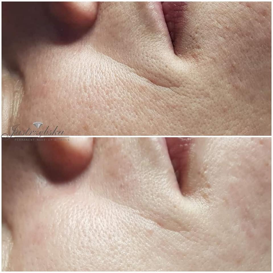 fot Katarzyna Jarzebska laserorapia zabiegi Chantarelle Przed i po