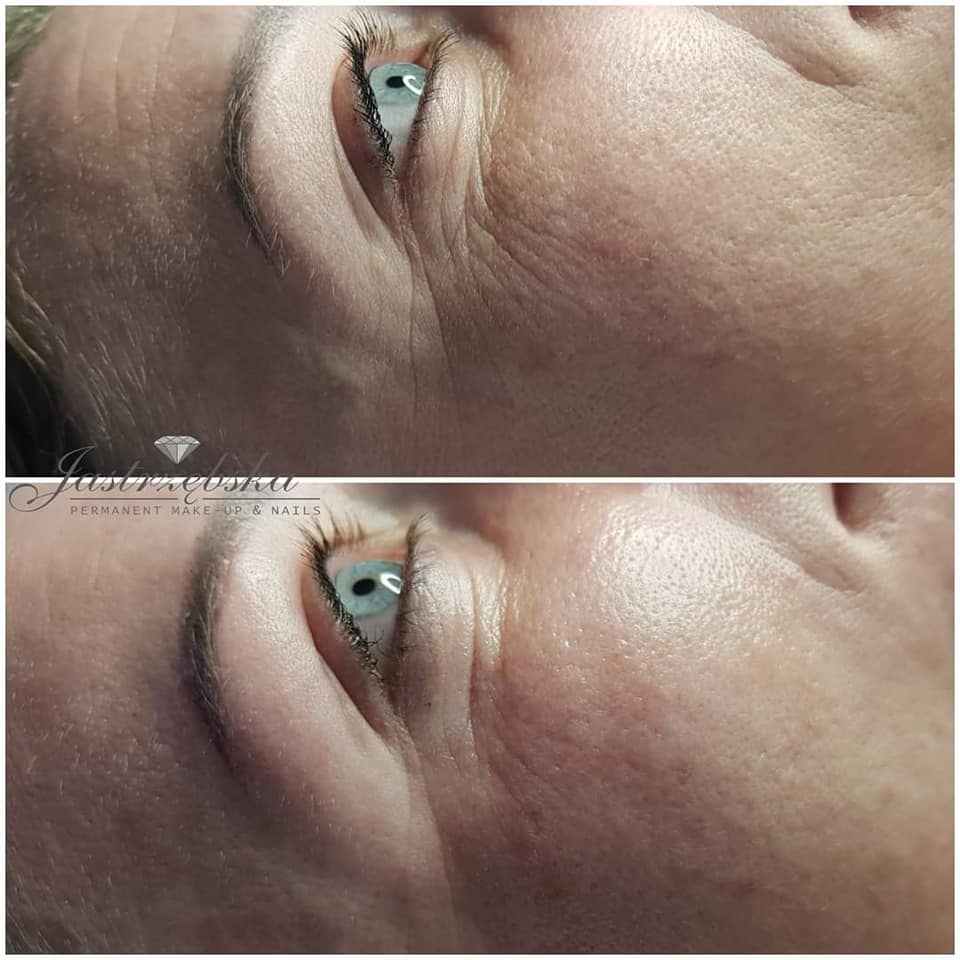 fot Katarzyna Jarzebska laserorapia zabiegi Chantarelle