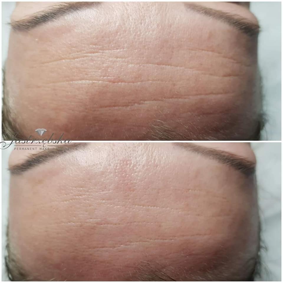 fot Katarzyna Jarzebska laseroterapia zabiegi kosmetyczne Chantarelle