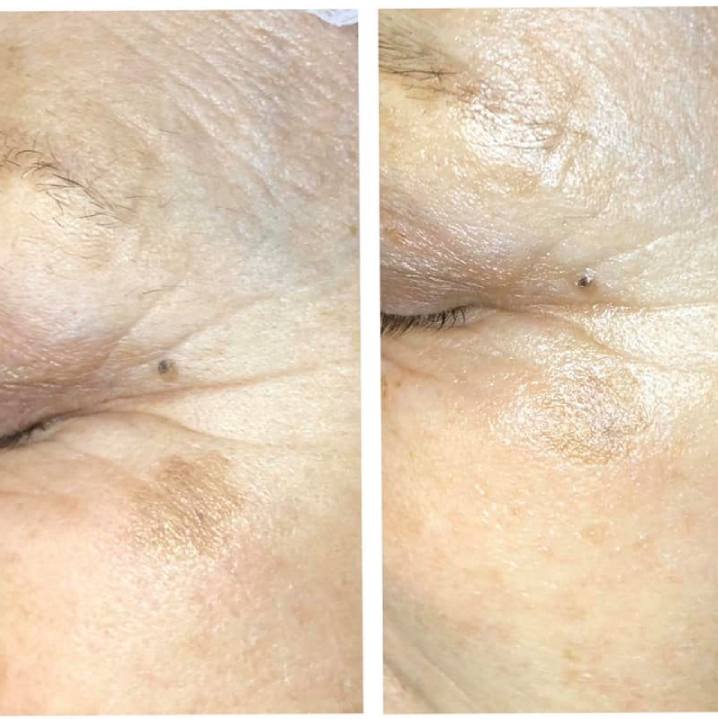 fot Ola Kaluzynska Melaner 46% 1 zabieg przed i po