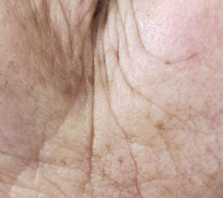 Glebokie zmarszczki wokol oczu bruzdy zabieg laserowy PO