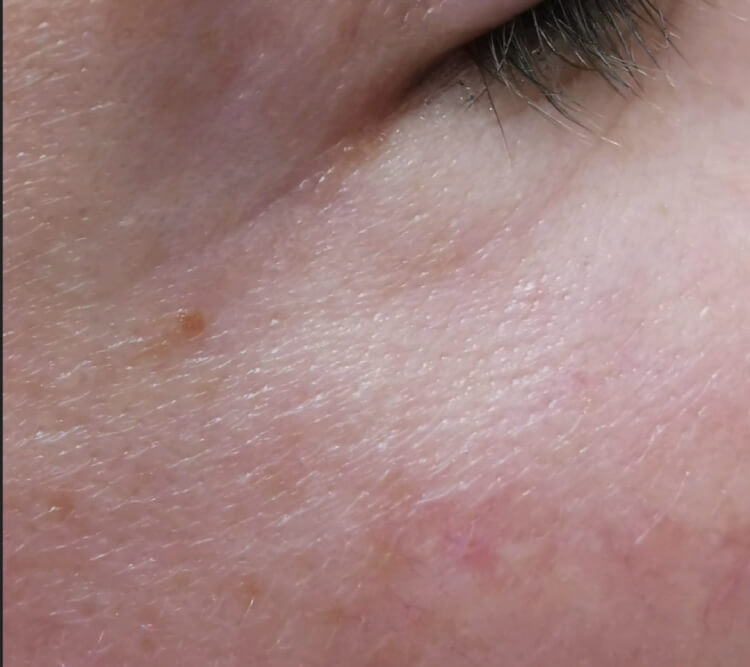 Popekane naczynka zmarszczki wokol oczu zabieg laserowy PO