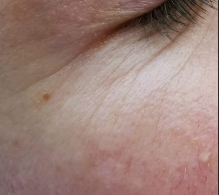 Popekane naczynka zmarszczki wokol oczu zabieg laserowy PRZED