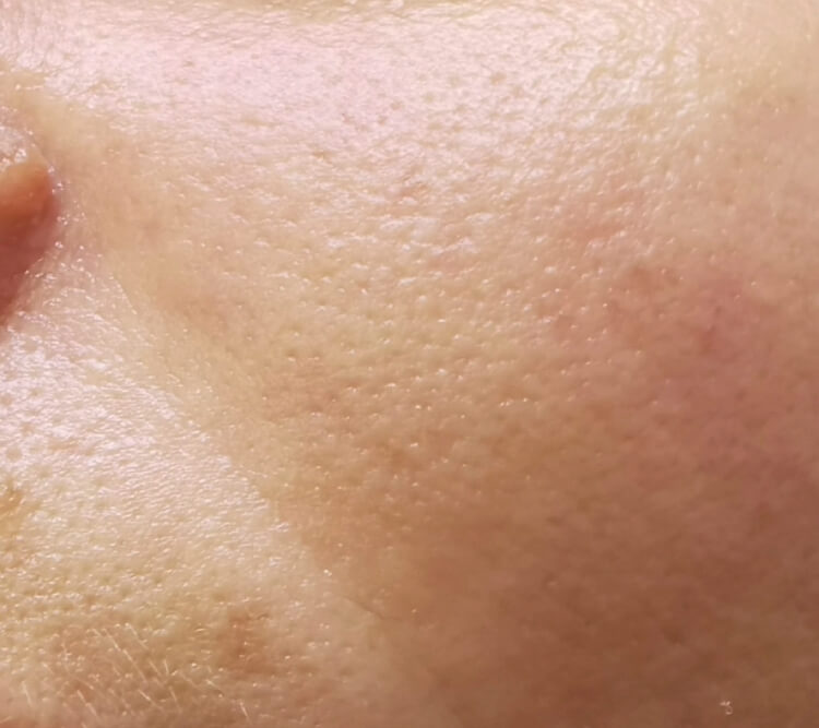 Rumien zaczerwienienie tradzik rozowaty zabieg laserowy PO