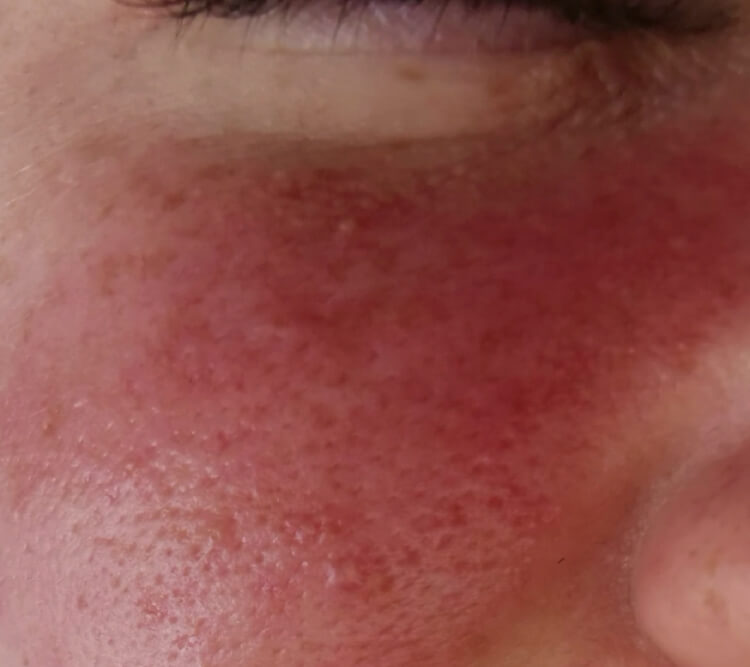 Tradzik rozowaty rumien zaczerwienienia zabieg laserowy PRZED