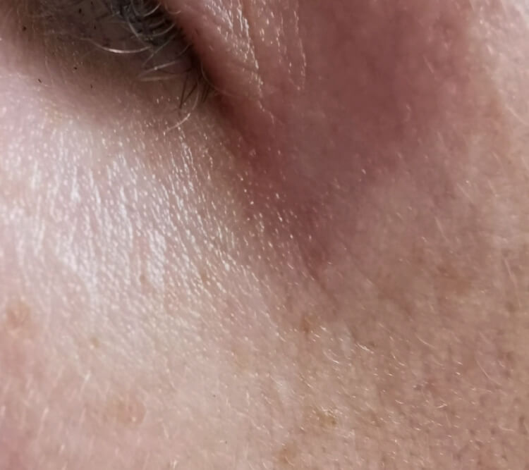 Zmarszczki wokol oczu PO zabieg laserowy