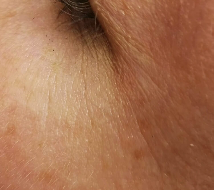 Zmarszczki wokol oczu PRZED zabieg laserowy