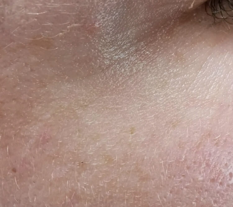 zabieg laserowy okolic oka PO