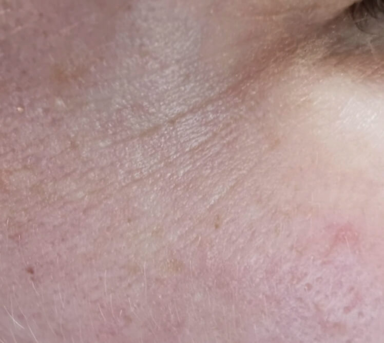 zabieg laserowy okolic oka PRZED