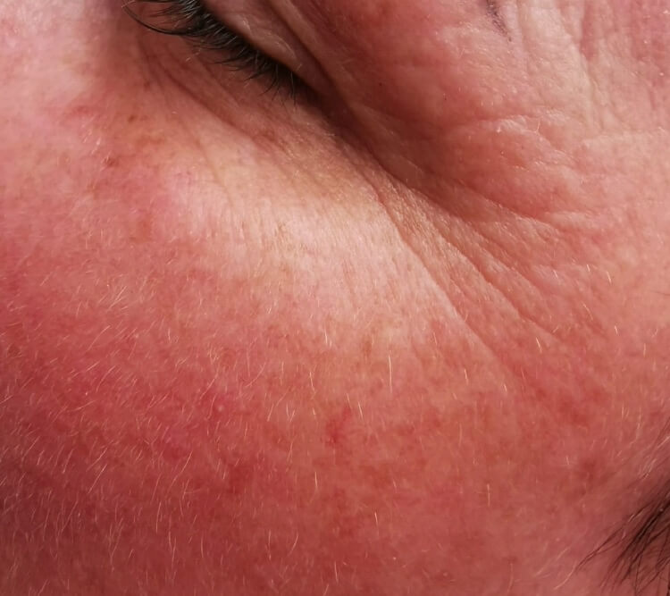 Zaczerwienienie skory naczynka zmarszczki wokol oczu PRZED